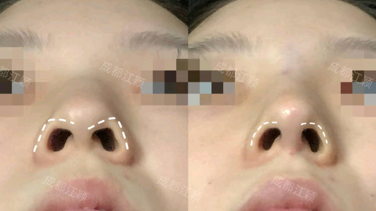 成都江颖注射修复鼻翼缘退缩 - 哔哩哔哩