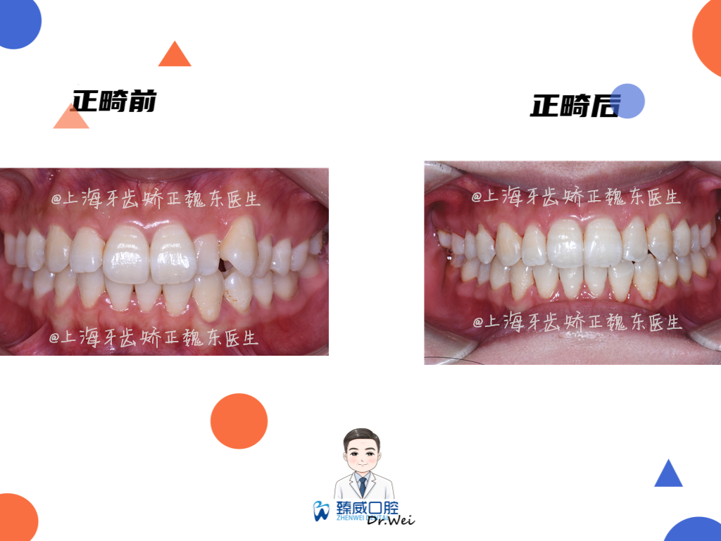 成都牙齿矫正（正畸）【案例】—牙列不齐+个别牙反颌+下颌轻微内收 - 知乎