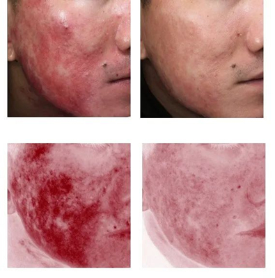 强脉冲光 祛红 (图片由医院提供)