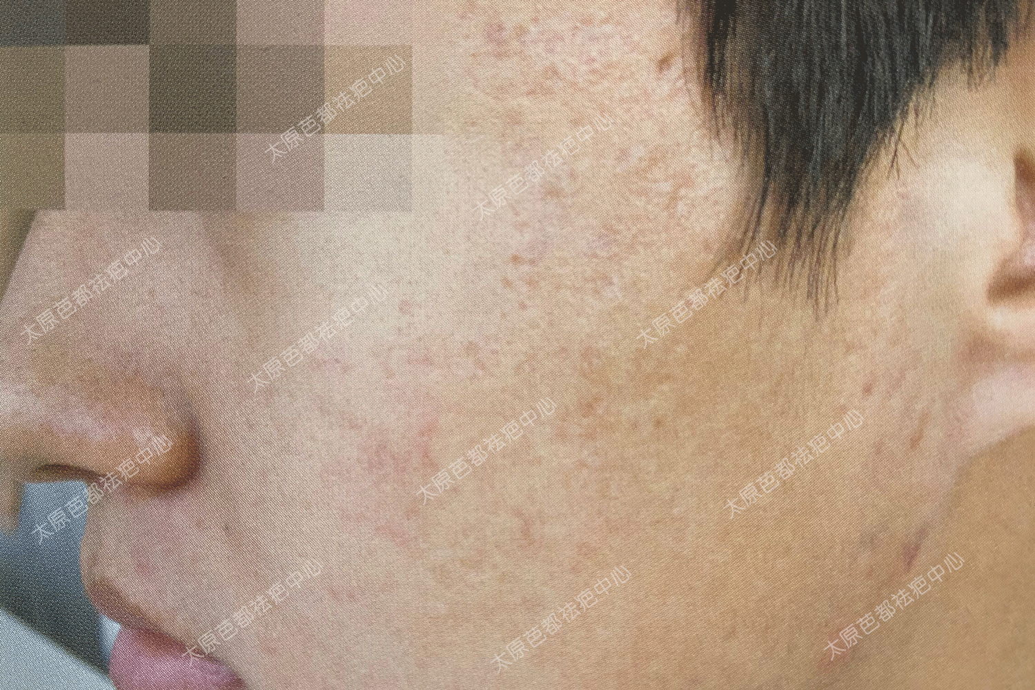 脸上有丘疹和痤疮的发炎皮肤。痤疮造成的疤痕照片摄影图片_ID:309094291-Veer图库