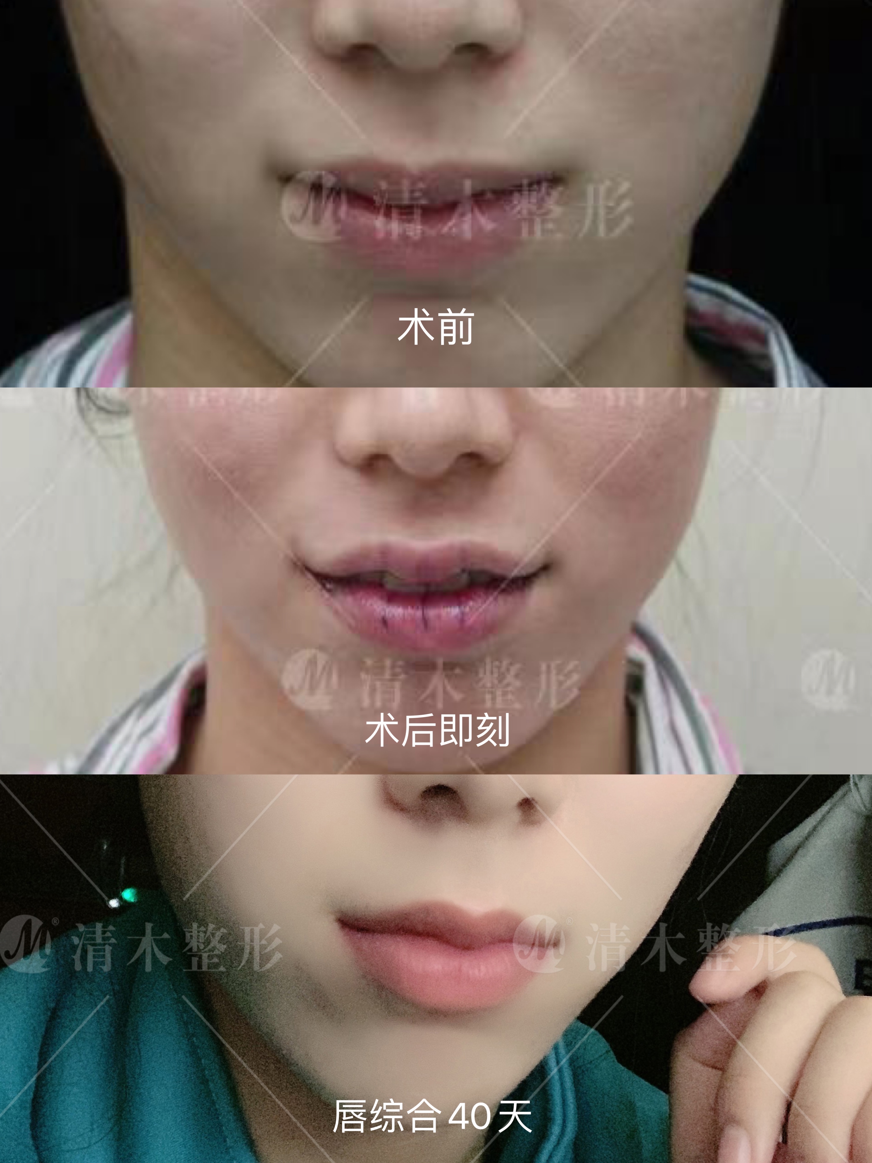 上海张玲医生唇部整形术改善唇形 - 知乎