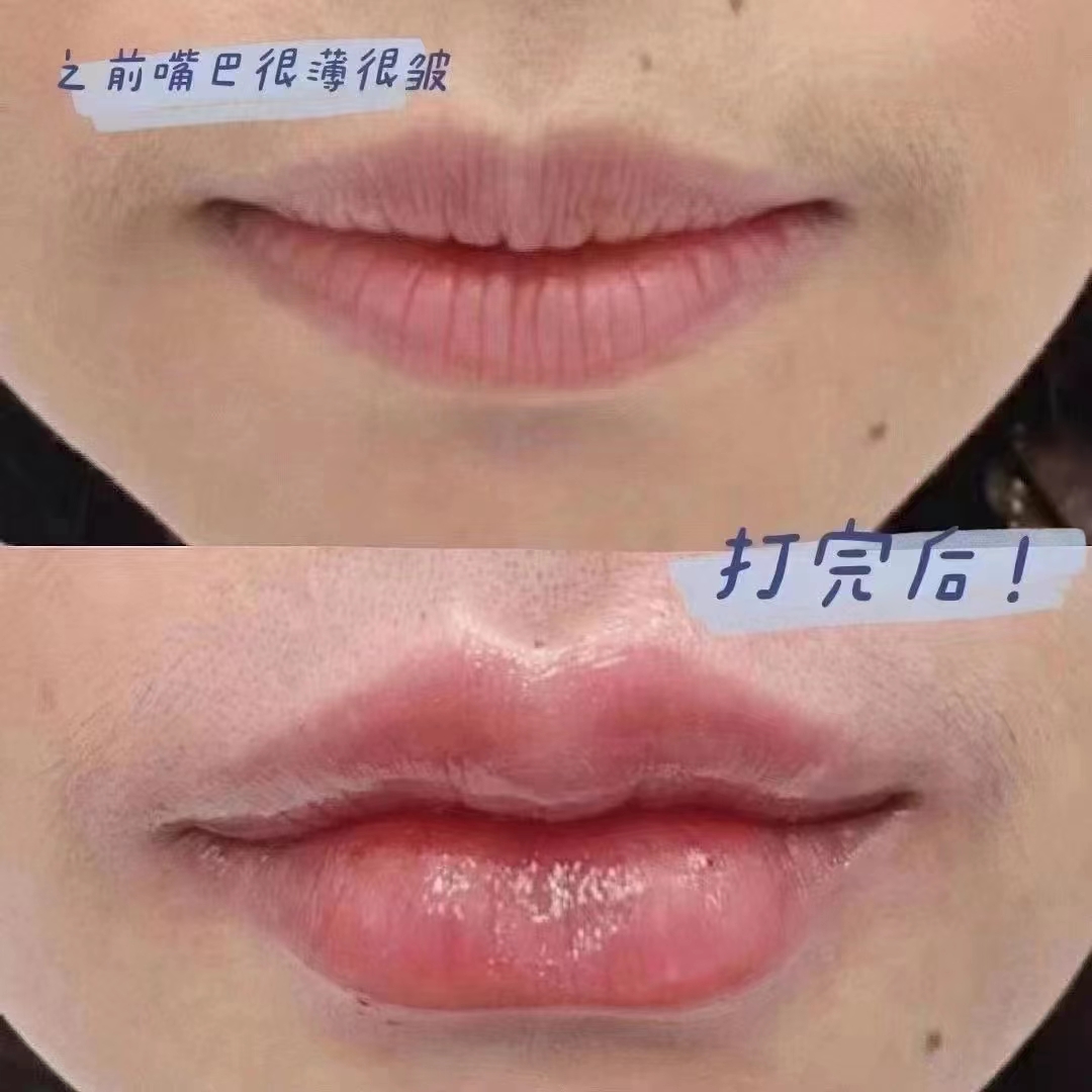 小百科：玻尿酸唇注射专科，专业打造完美唇形-蜜颜优惠