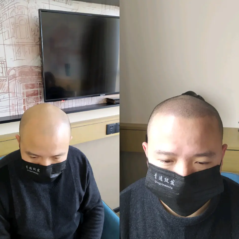 纹发也叫smp(scalp micro pigmentation)头皮微着色技