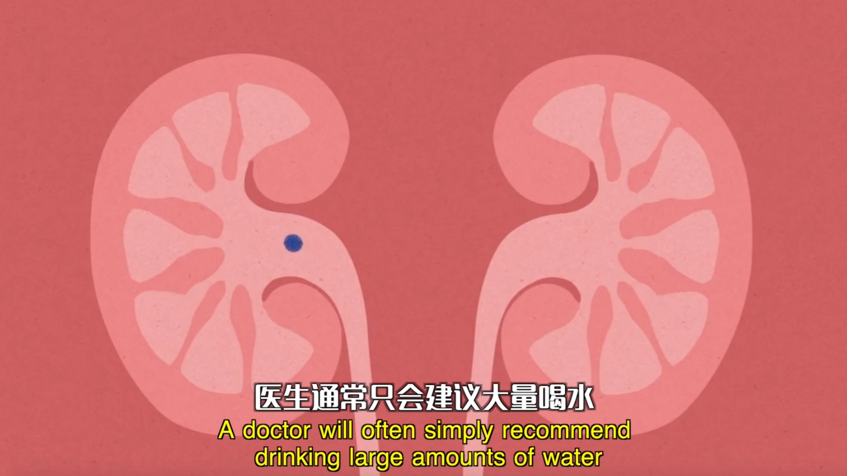 造成肾结石的原因是什么？/What causes kidney stones? 「快科普」 哔哩哔哩