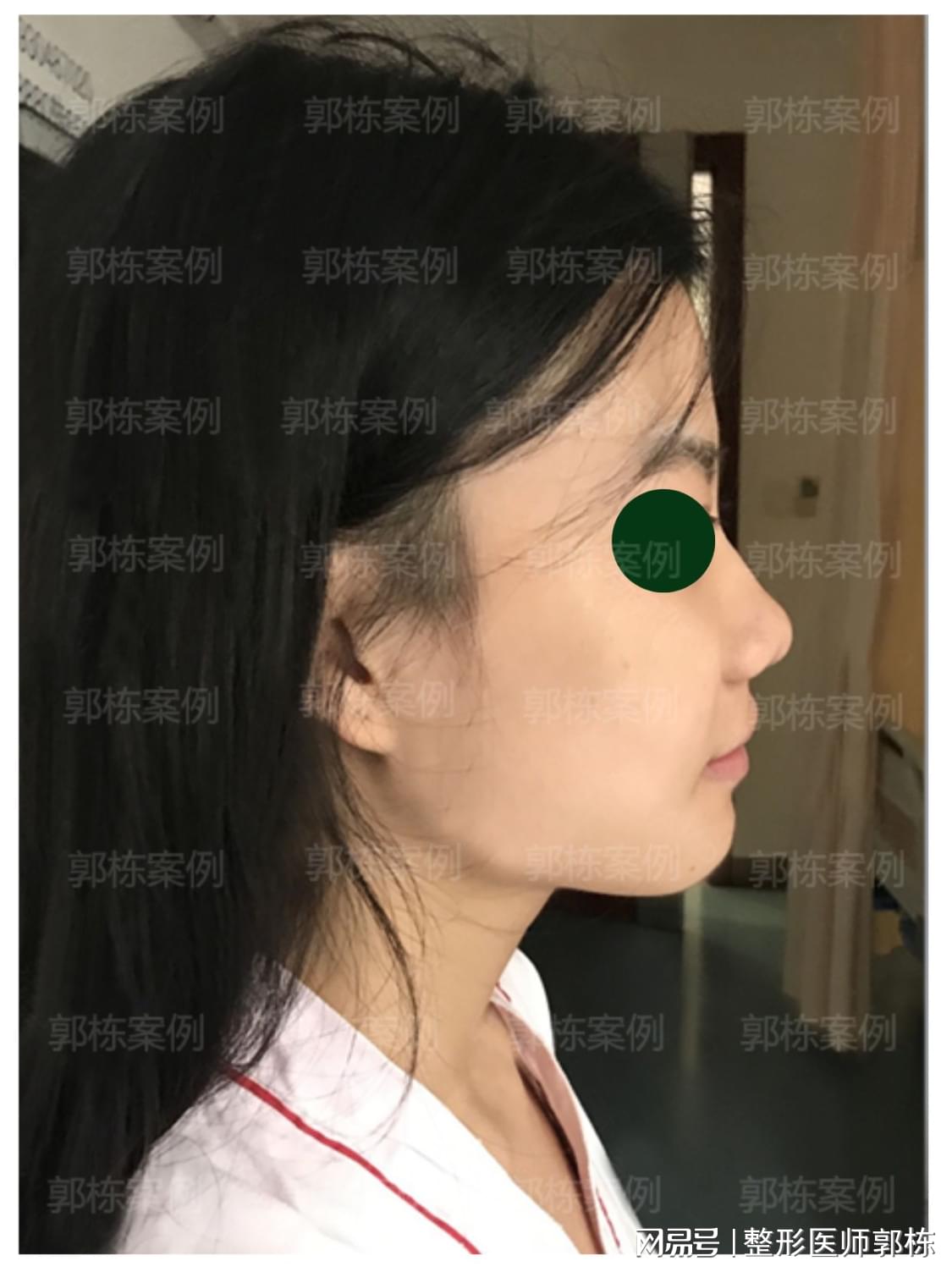 鼻整形美学设计标准与五种鼻整形塑造-赵丹-爱问医生