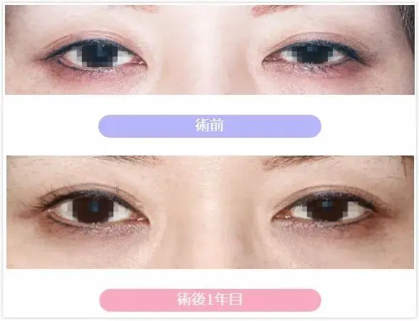 优酱名医图鉴 双眼皮全切 人中缩短术专家 酒井伦明 哔哩哔哩