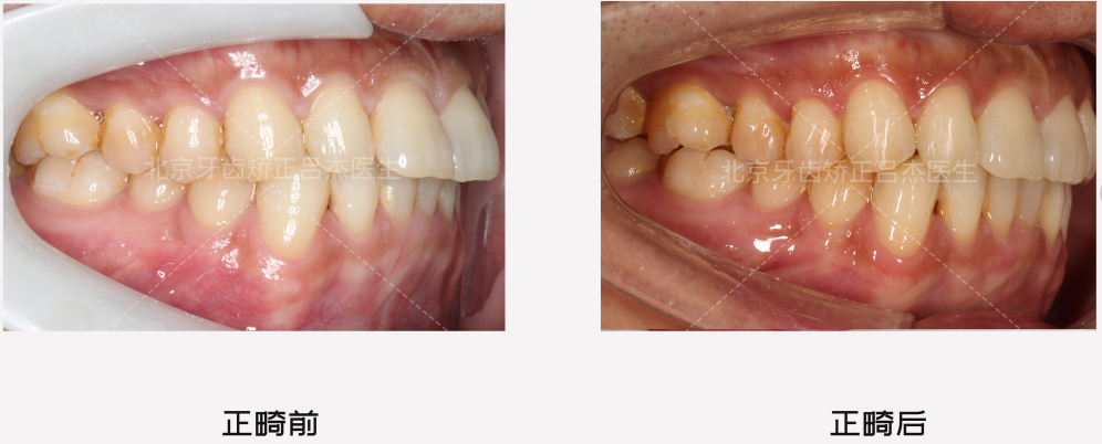 北京隐形矫正 牙齿拥挤没有拔牙,我们用适量的片切和扩弓代替!