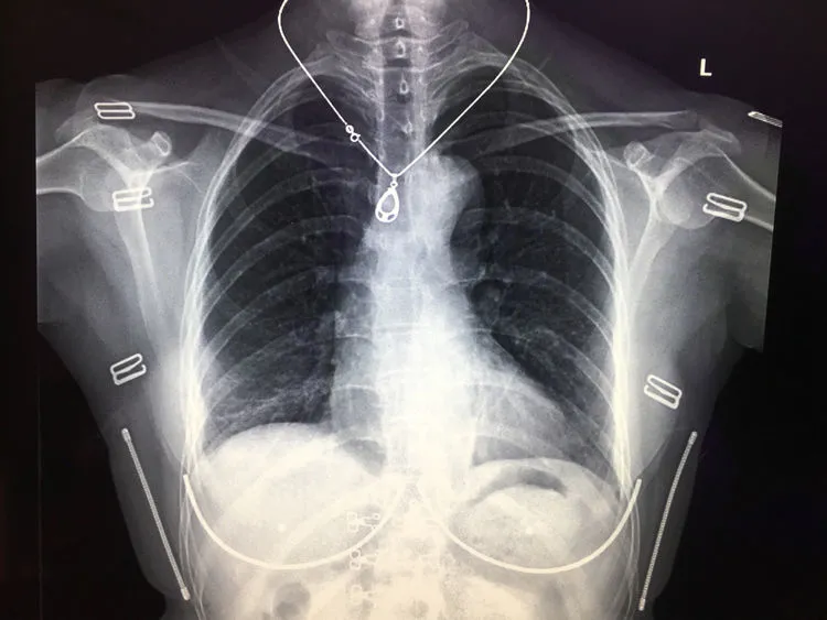 存在体表金属异物的胸部正位平片,图片来自镇安县医院影像科