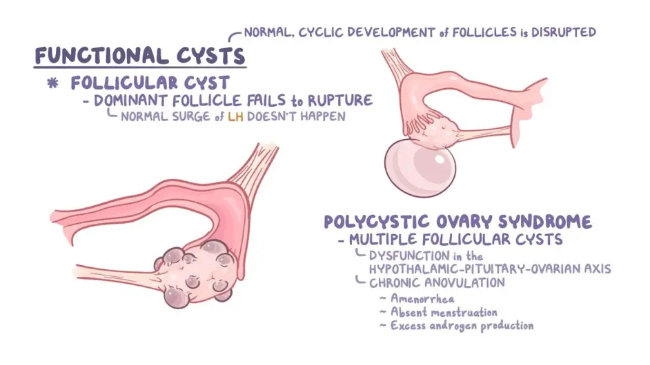 Ovarian cyst 中文