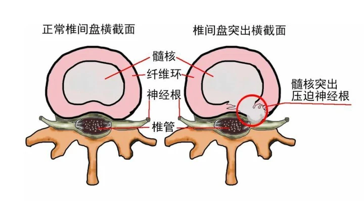 腰椎间盘突出症压迫神经会给身体造成怎样的影响？ 哔哩哔哩