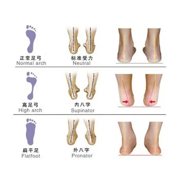 功能性低弓足 扁平足 足外翻 足弓塌陷 踝关节不稳定成因及康复思路 哔哩哔哩