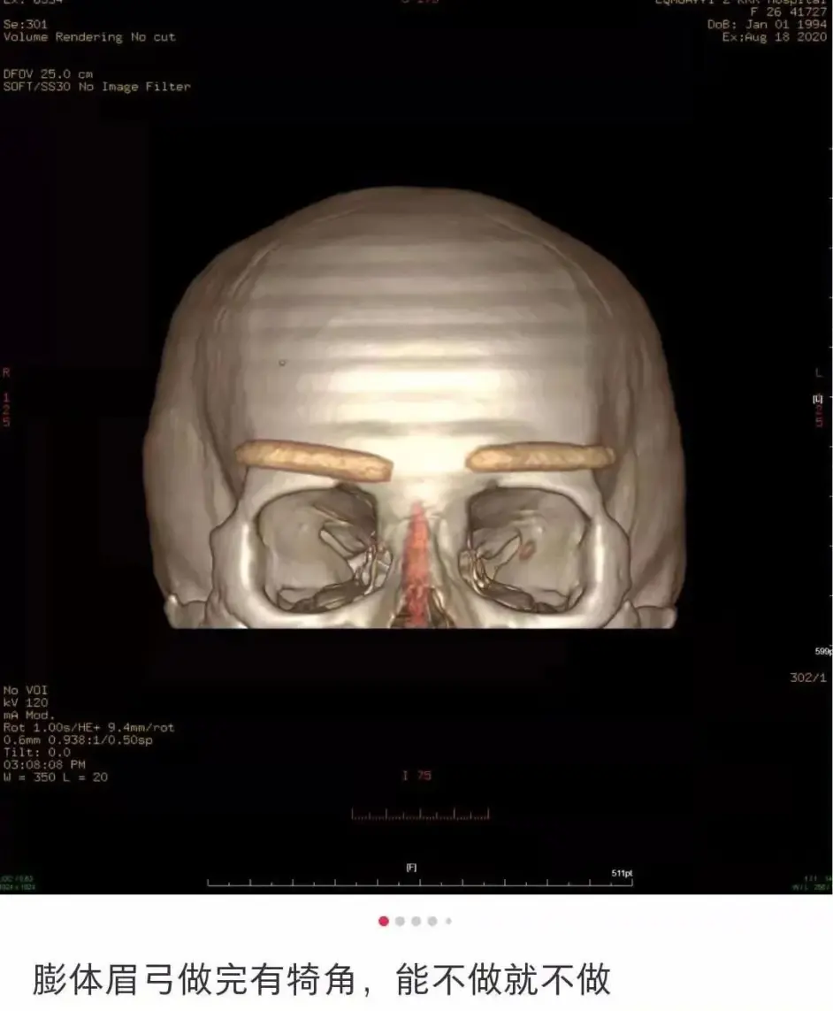 眉弓骨假体 是美丽还是危险 哔哩哔哩