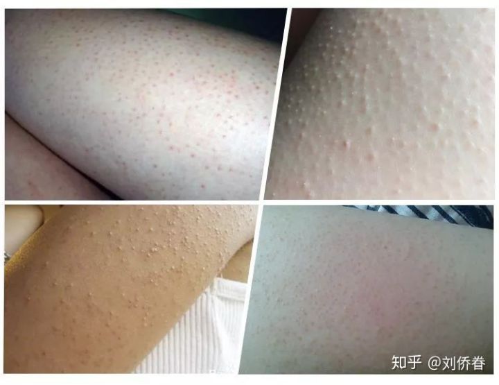 鸡皮肤擦什么好很光滑(鸡皮肤擦什么好很光滑不痒)