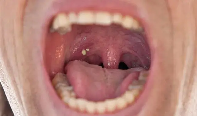 10 以上的人 扁桃体上都会长结石 哔哩哔哩