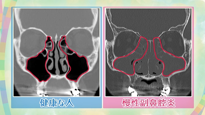 3. 生理食塩水で洗い流す