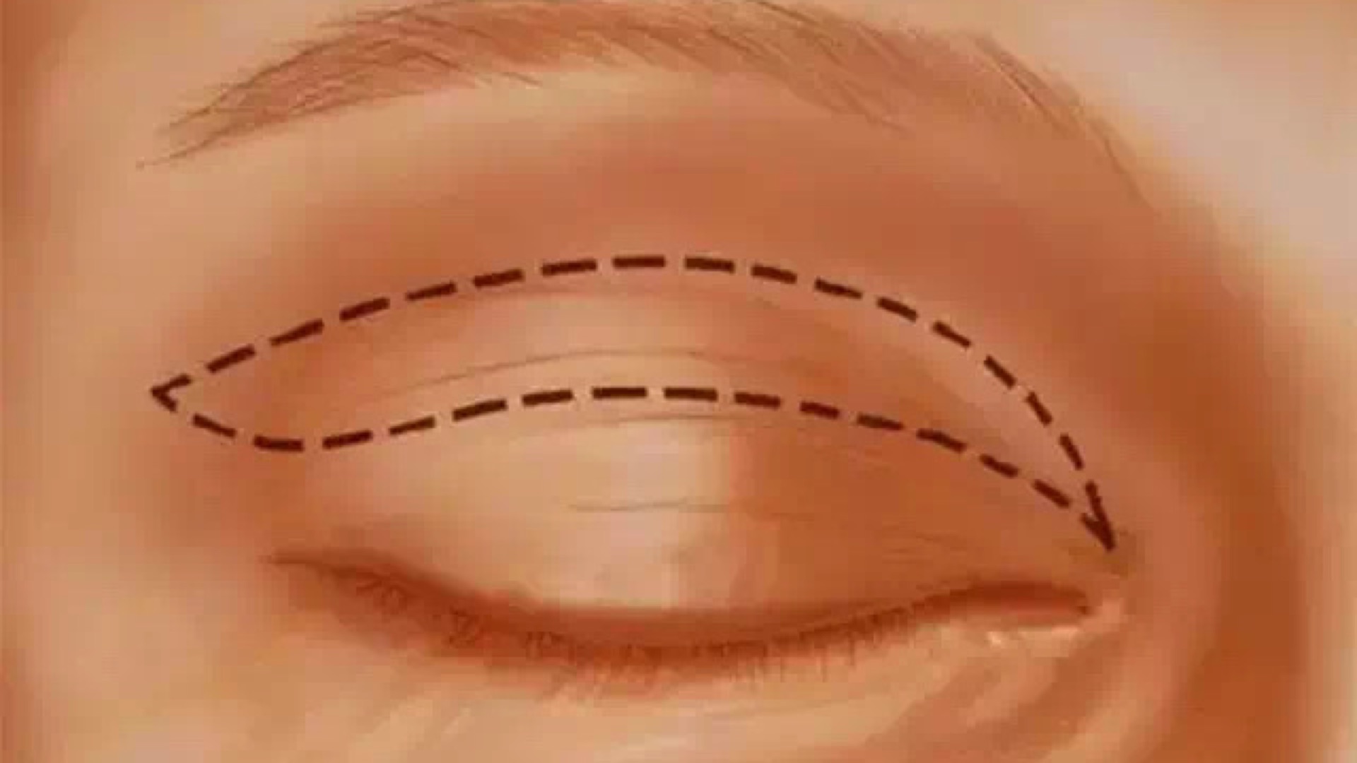 切开双眼皮+埋线双眼皮的手术方法和术后注意事项！ - 知乎