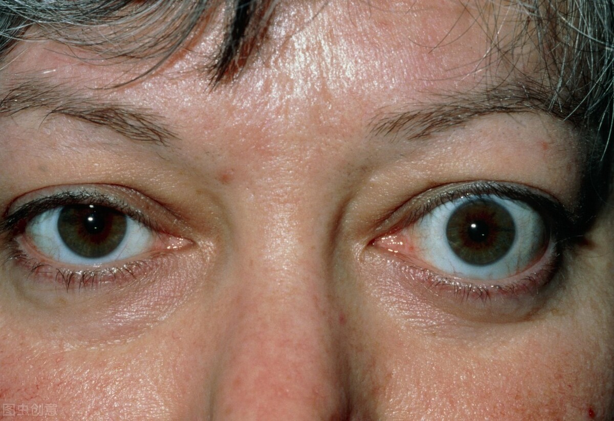 甲亢突眼的有效治疗方法_甲亢突眼_甲亢突眼 - 好大夫在线