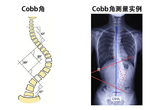 石家庄直乐大讲堂：Cobb角大于多少度为脊柱侧弯 - 哔哩哔哩