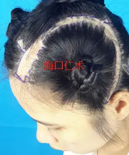 海口植发正规(海口植发正规医院排名榜碧 莲盛好评)