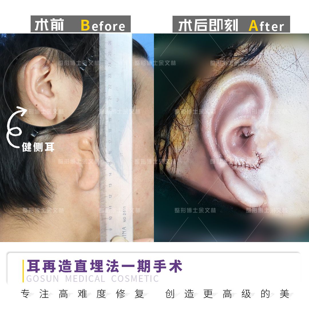 第八节 耳部烧伤后畸形缺损的修复