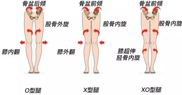 如何判断你是x型 O型 Xo型腿 哔哩哔哩