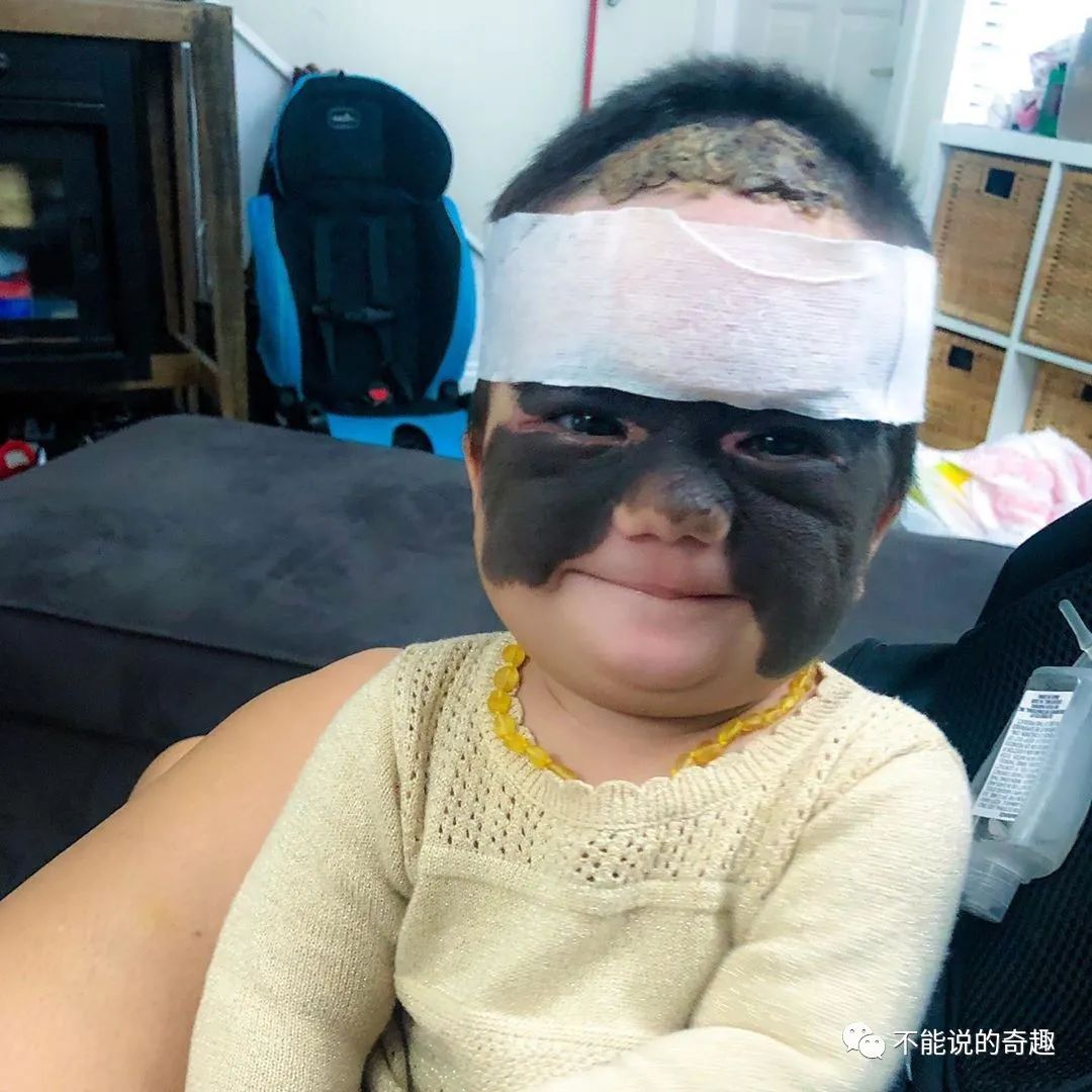 配以激光治疗减少色素沉着,从而一点点地消除露娜脸上的黑色素细胞痣
