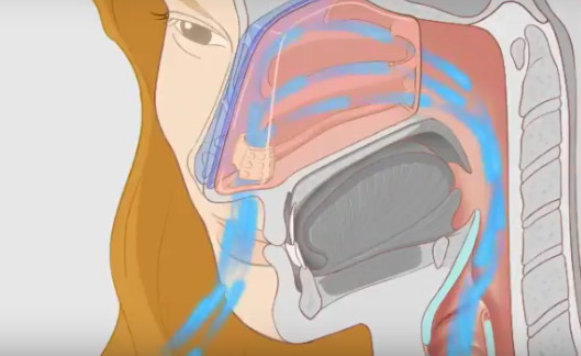 【技术邻】推出鼻腔领域的"隐形眼镜",「assistent」想解决鼻塞打鼾