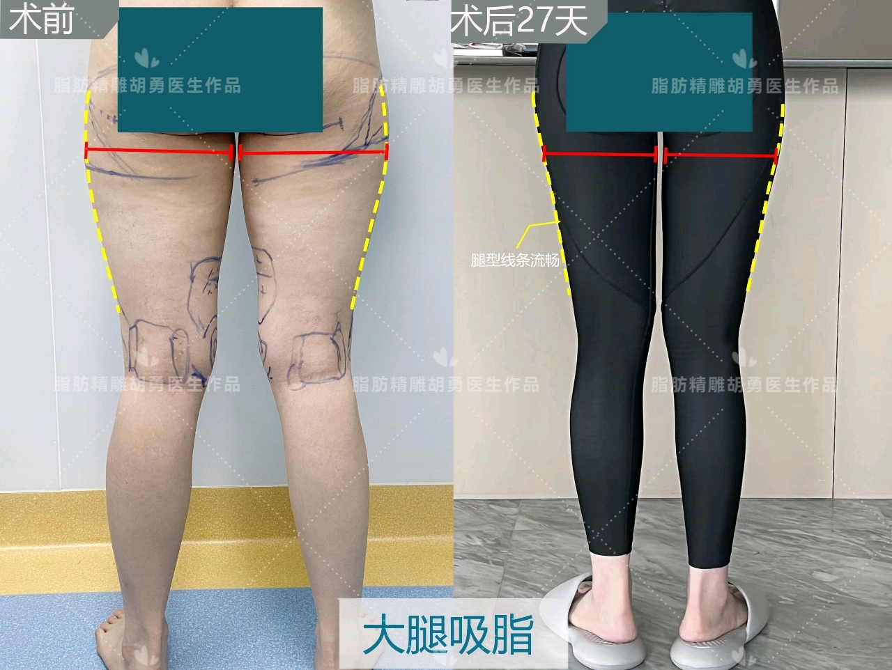 【直腿塑形】宝丽太大腿环吸修复+假跨+膝内侧5个月反馈 - 知乎