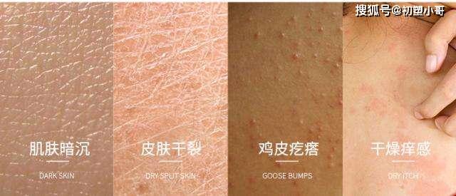 鸡皮肤发炎是不是会长痘(鸡皮肤发炎是不是会长痘痘)