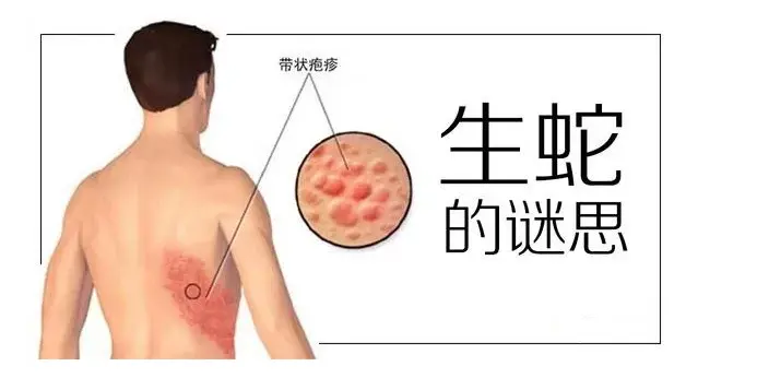 飞蛇 生蛇 带状疱疹 皮肤病有疫苗了 哔哩哔哩