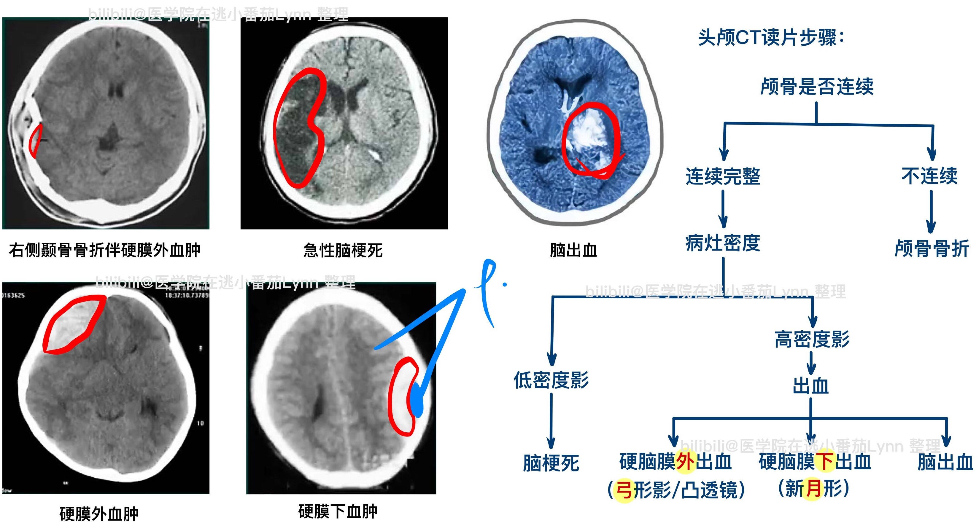 一、颅脑正常CT解剖-CT读片指南-医学