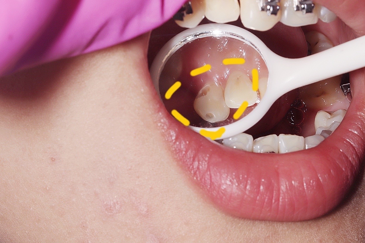 龋齿的处理前后对比照