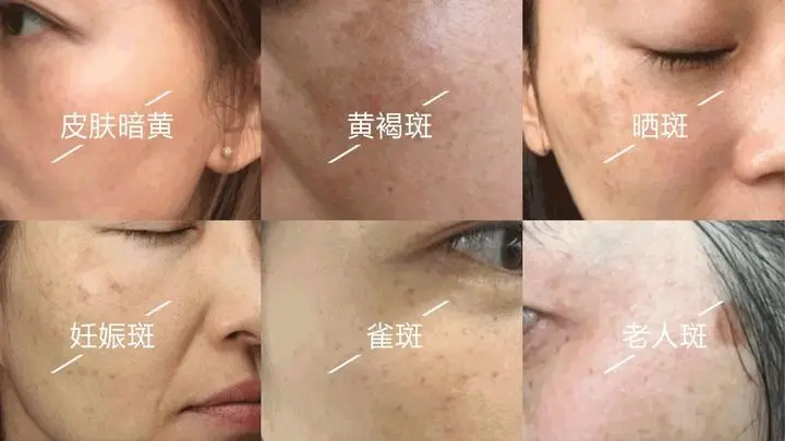 怎样才能快速祛斑美白 脸上长斑怎么样才能去除 哔哩哔哩