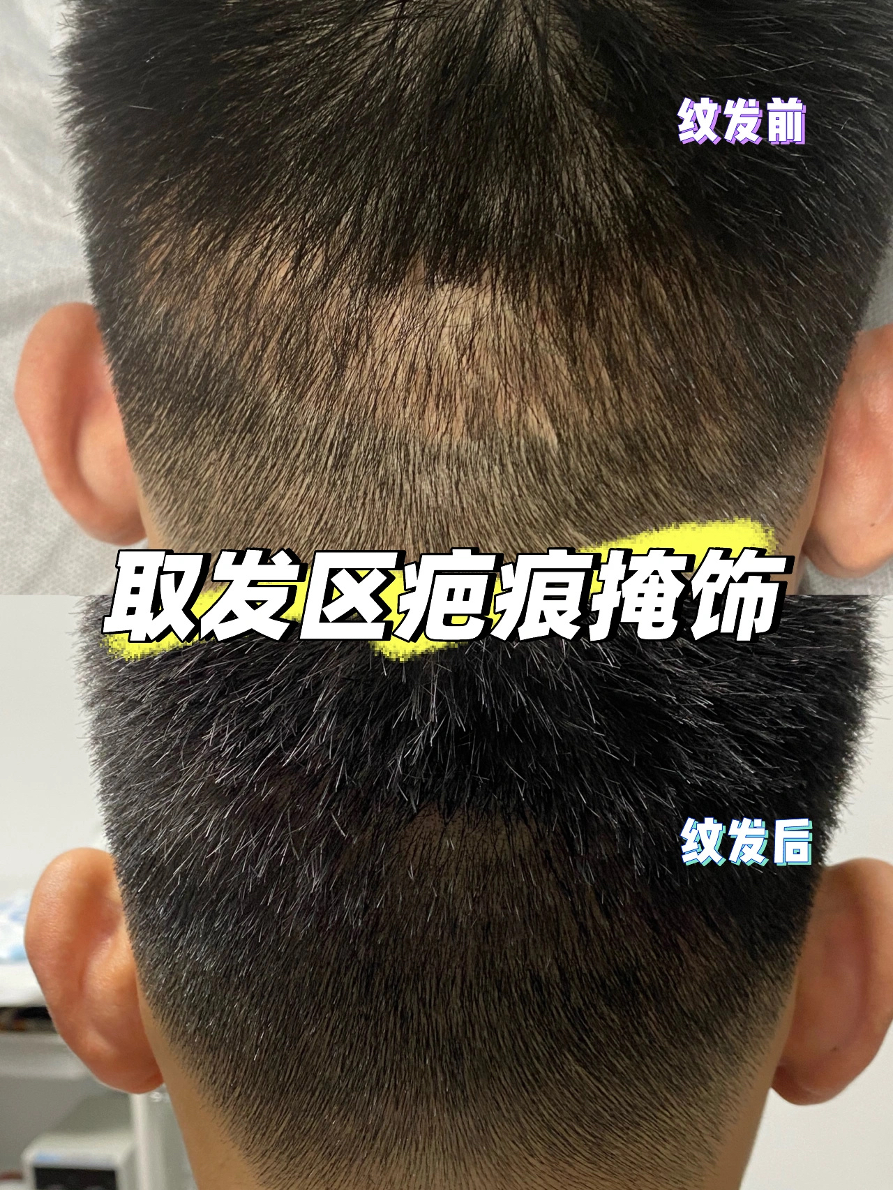 FUE植发后取发区疤痕掩饰+头顶稀疏加密典型案例-蜜颜优惠