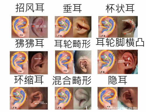 【小耳科普】耳廓形态畸形的类型?