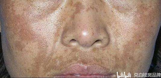 祛斑霜哪个牌子好?