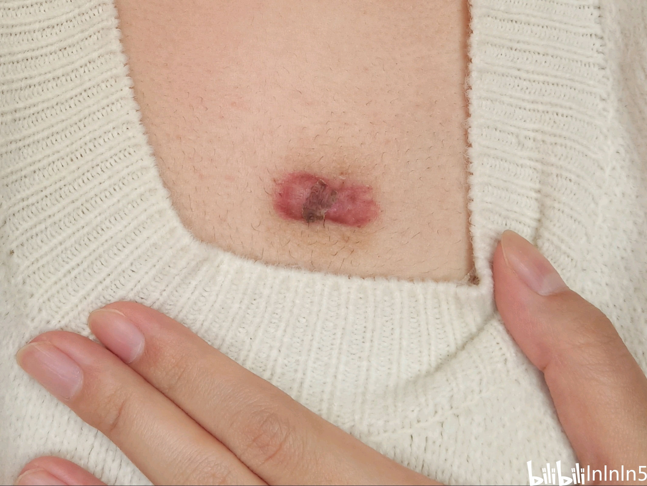 疤痕疙瘩锶90福州同位素