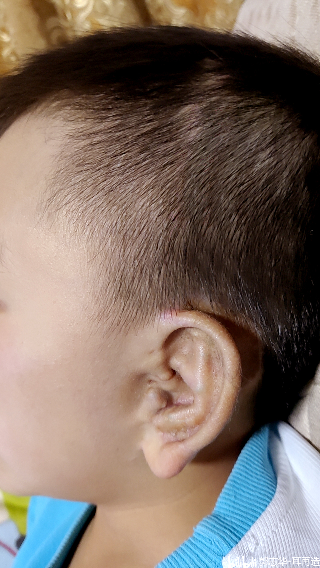 新生儿耳朵畸形怎么办？新生儿外耳畸形怎么治疗？_小耳畸形_小耳畸形 - 好大夫在线