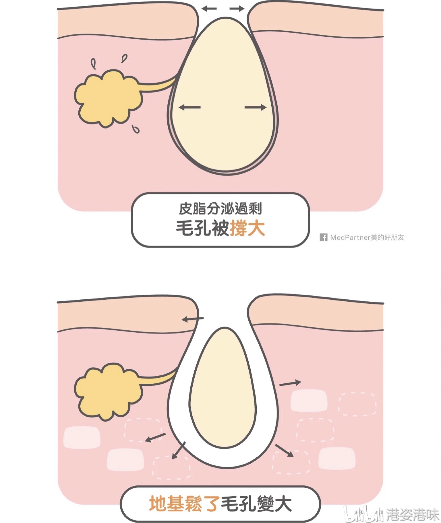 护肤| 毛孔能插葱?别怕,还有得救!