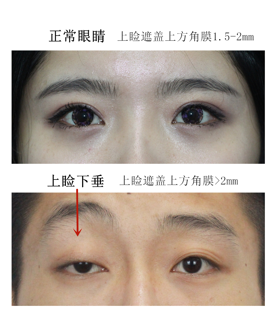 眼瞼下垂症手術、術後3ヶ月 | TETSU形成・美容クリニック 田中哲一郎のブログ