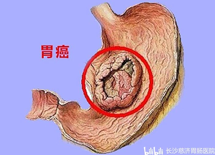 26岁胃癌晚期只剩6个月,23岁妻子翘首盼奇迹!