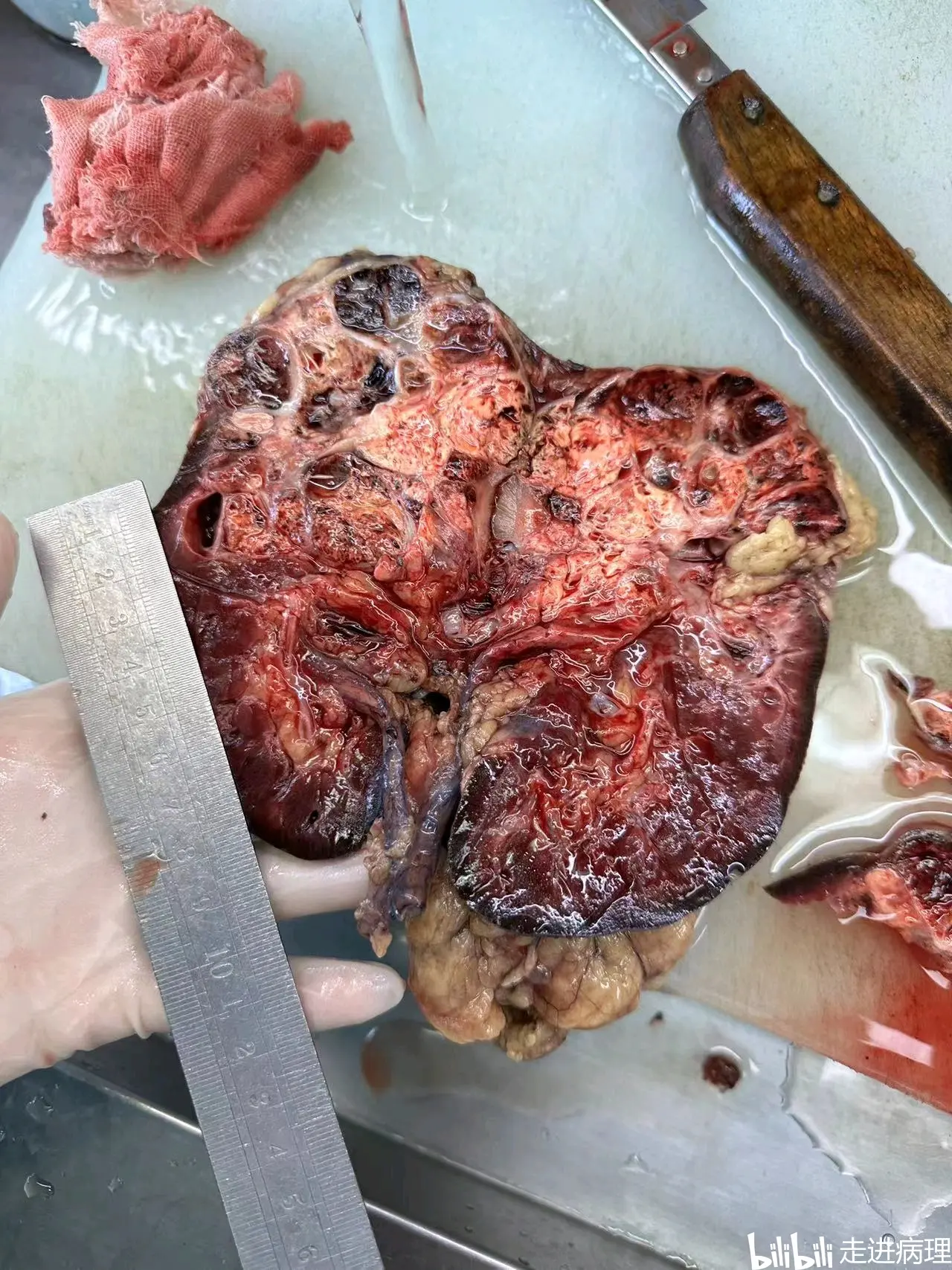 肾癌?既可怕又不可怕的癌!