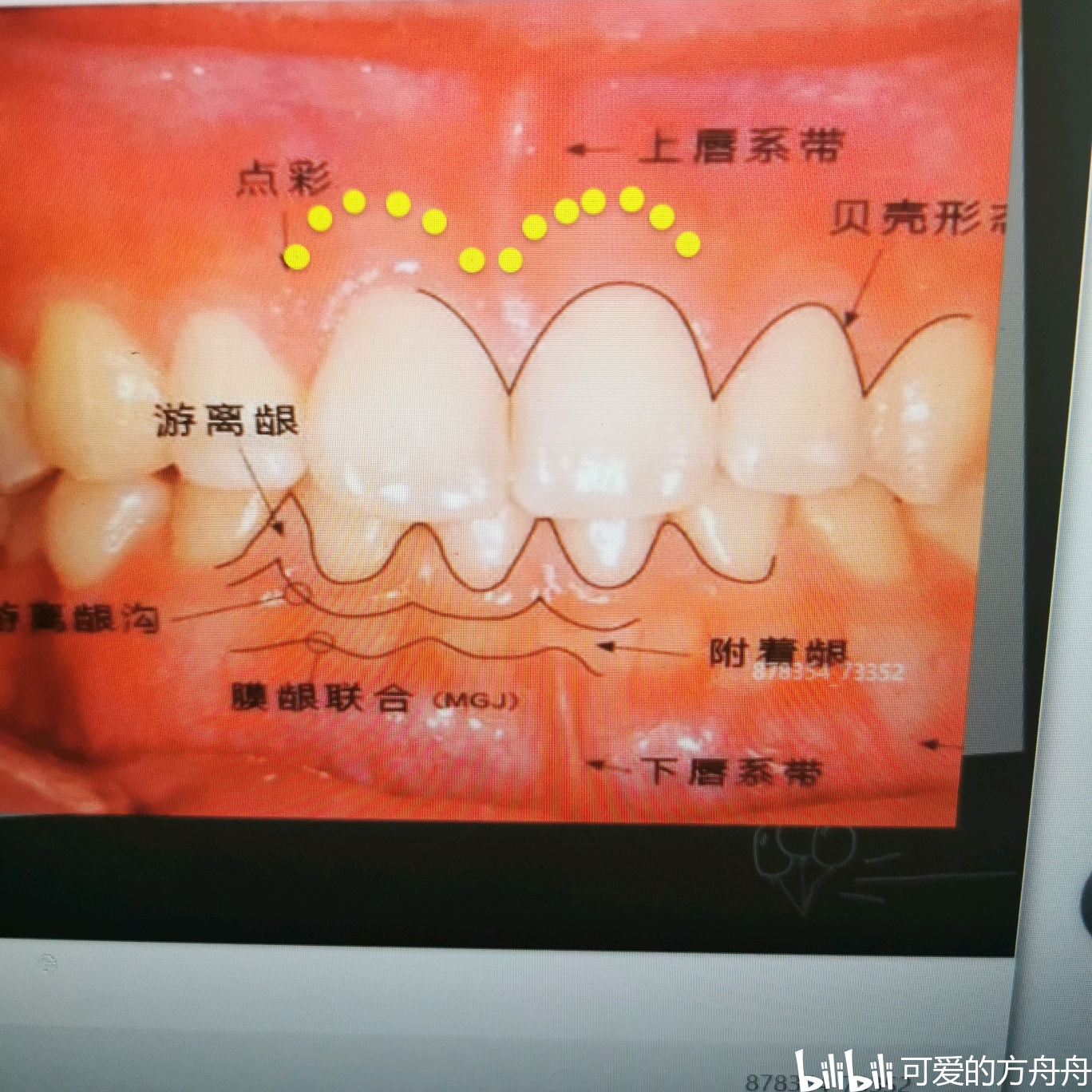 急 ! 急 ! 这是牙龈线性红斑么? 还是一般的牙龈红肿?_百度知道