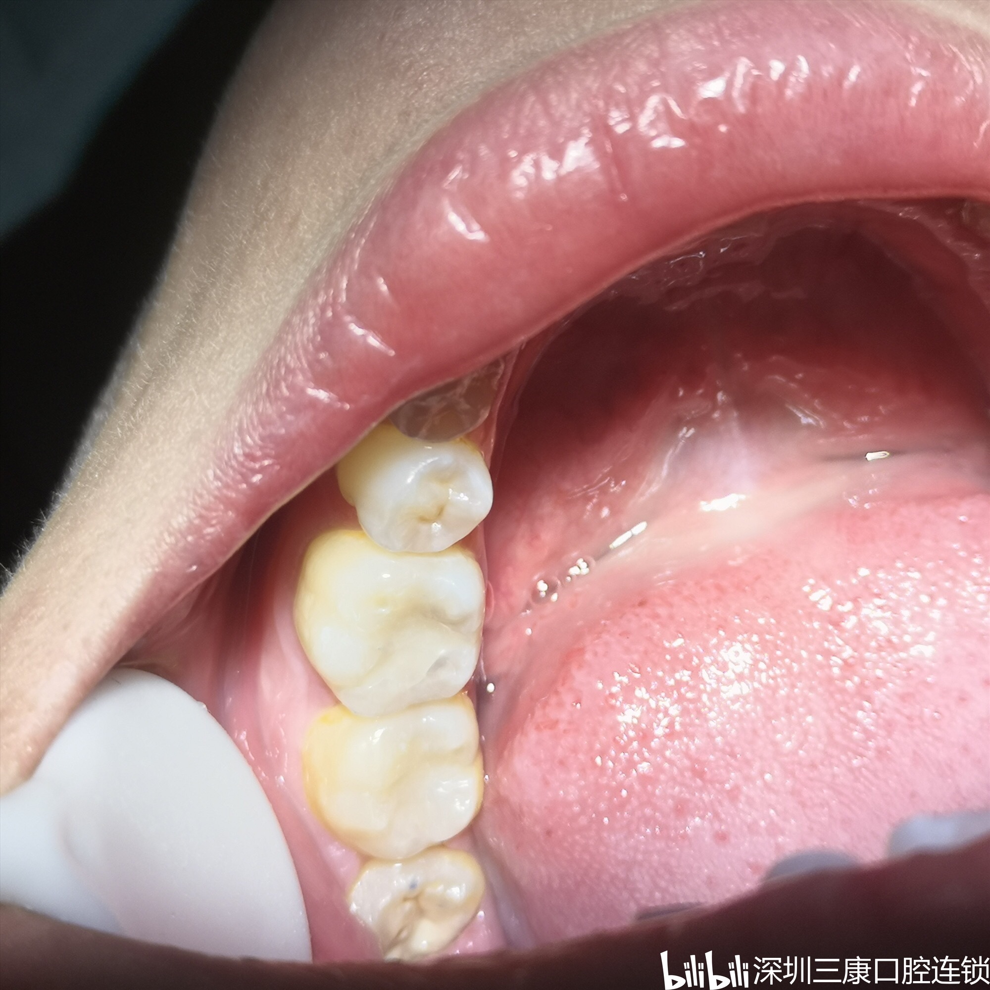 再治疗银汞合金补的牙，用树脂充填补牙。 - 知乎