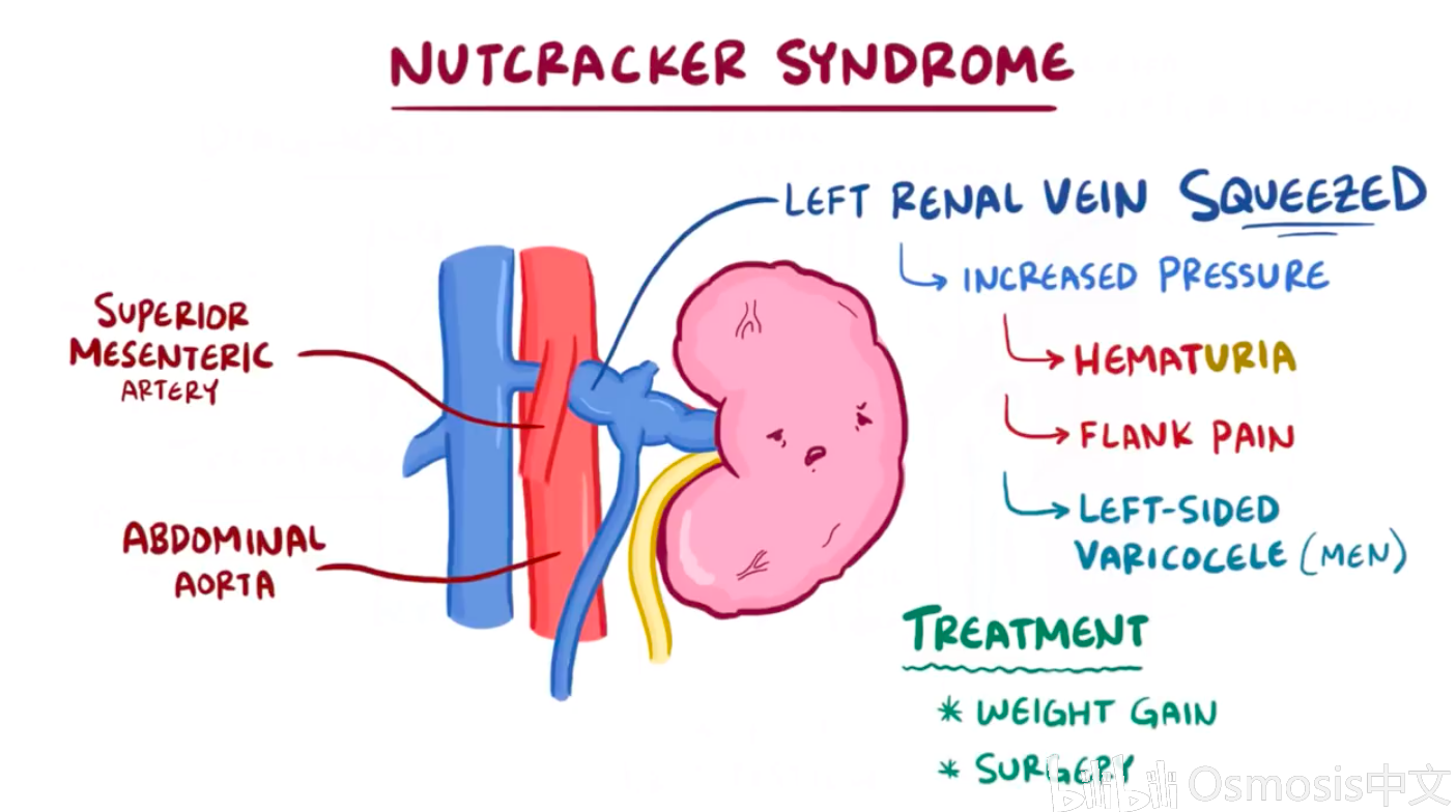 Nutcracker Syndrome Genetic At Derek Alexander Blog Nutcracker Syndrome Genetic At Derek Alexander Blog