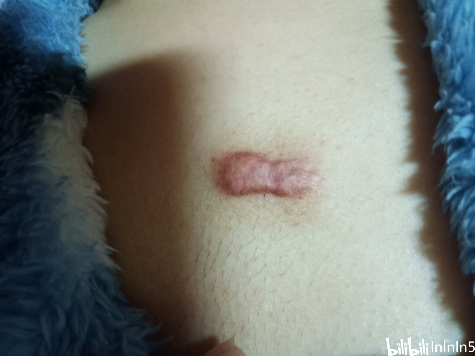 疤痕疙瘩锶90福州同位素