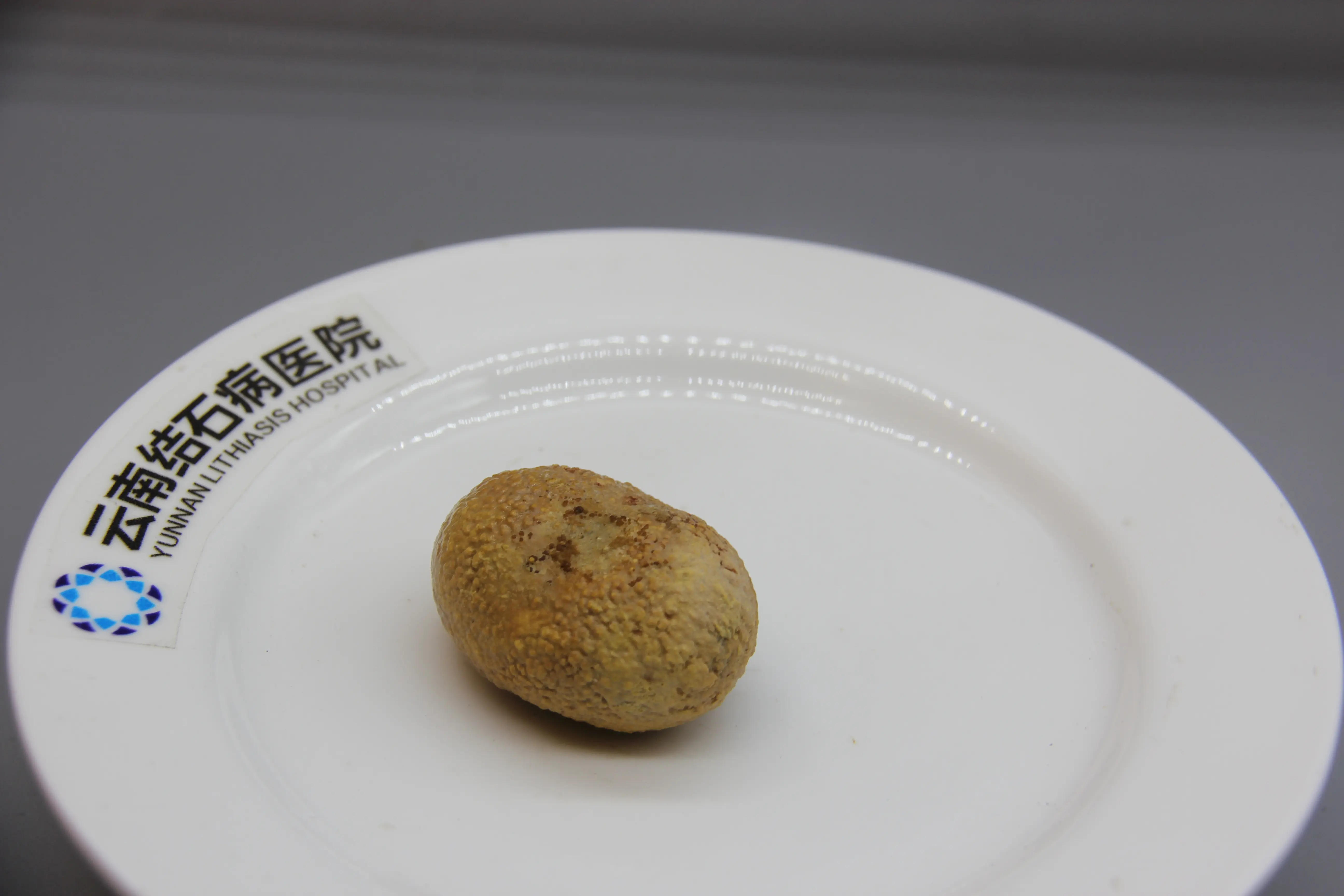 昆明尿结石医院科普:泌尿结石的「疼痛排行榜」,最疼的竟然是这里