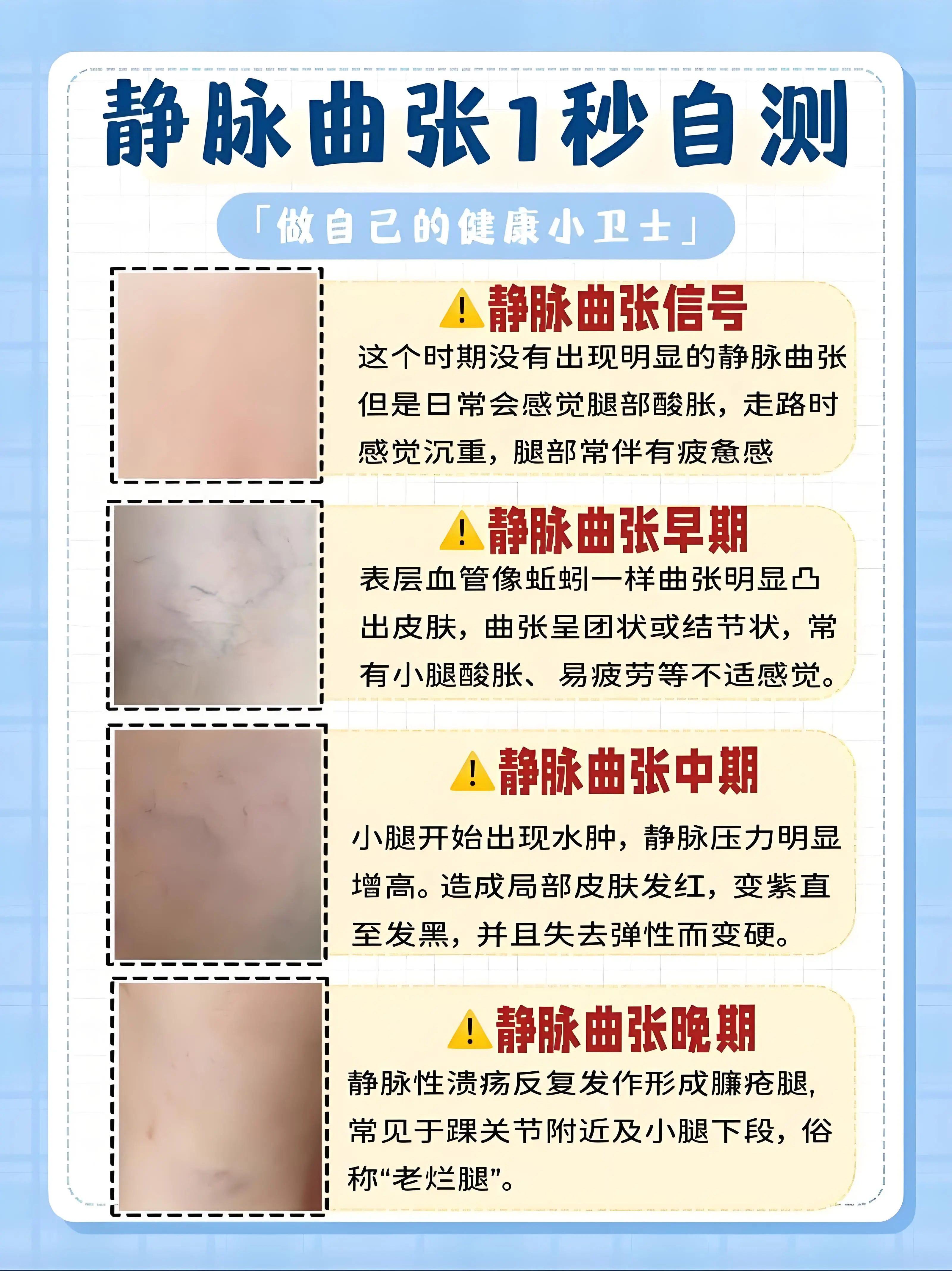 qk纤溶酶如何帮助预防和改善静脉曲张?让你的双腿不再"曲张"!