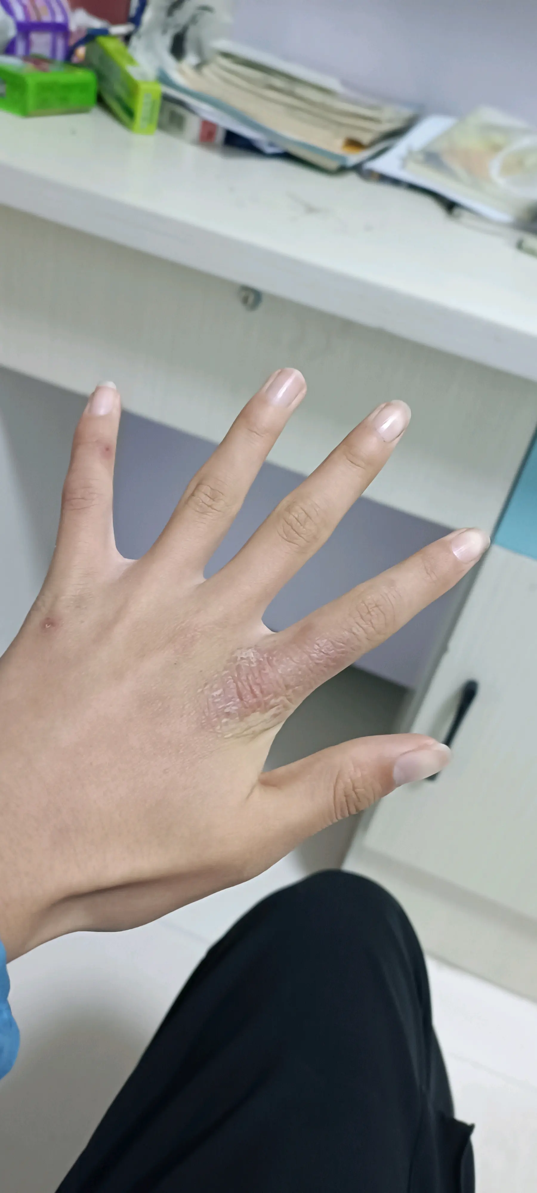 奶奶的冻疮给我玉手干成这样