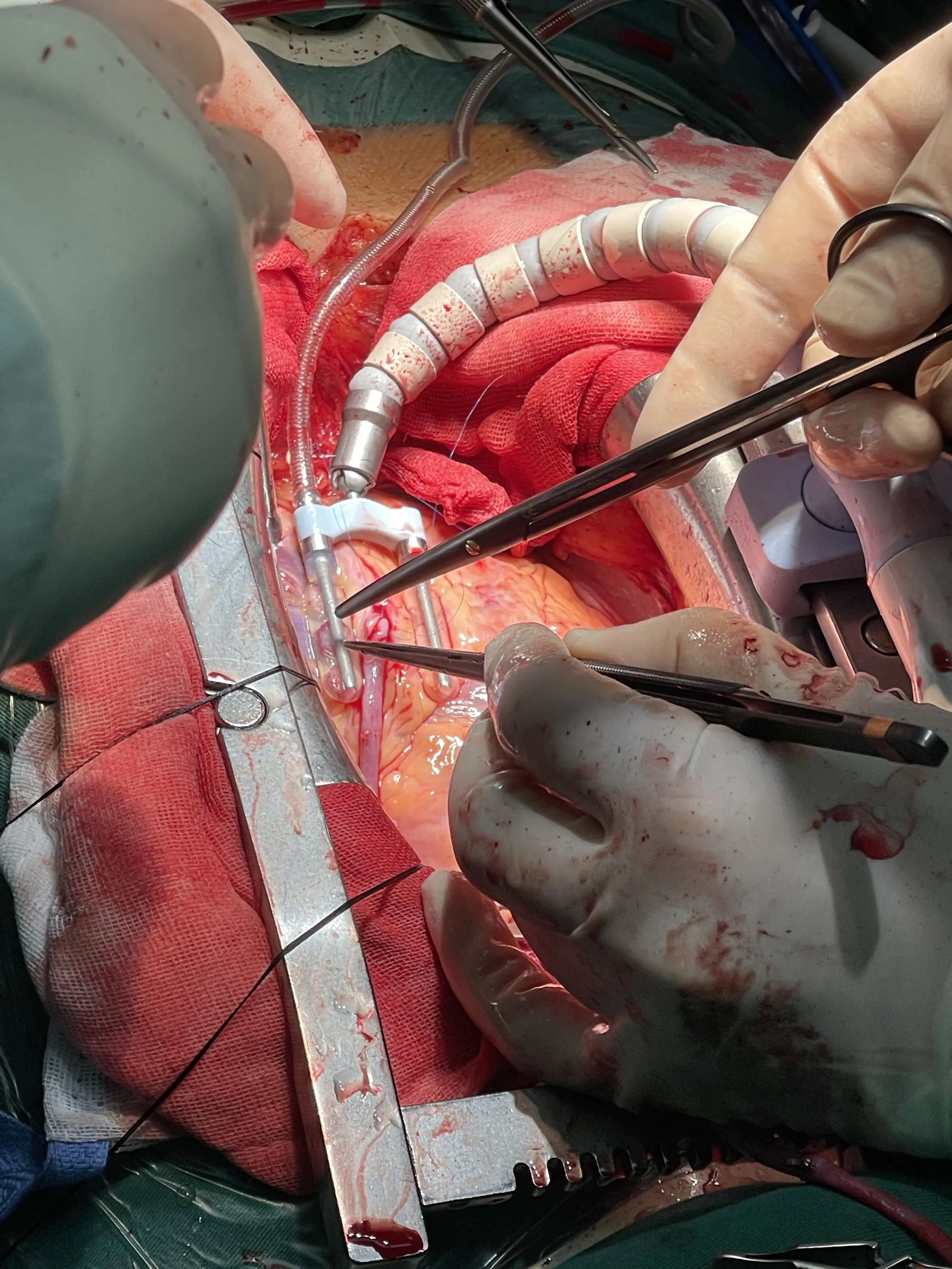 不停跳主动脉冠状动脉搭桥术主动脉夹层bentall椎间盘突出镜下椎管